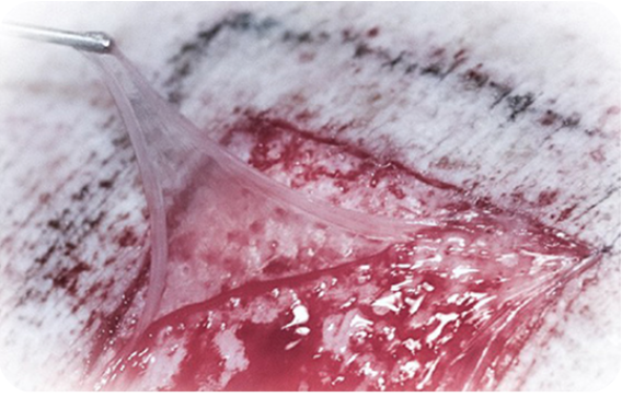 Transforming Healing: The Expanding Role of Amniotic Allografts in Modern Medicine