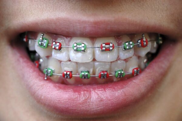 Smile Transformations: Straightening Your Teeth at Any Age braces for adults