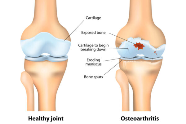 Osteoarthritis ICD-10 Code: Everything You Need to Know Osteoarthritis icd 10